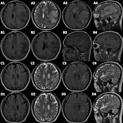 Case report: MOG-IgG-associated encephalitis with Epstein-Barr virus infection and Alzheimer's pathologic change in cerebrospinal fluid